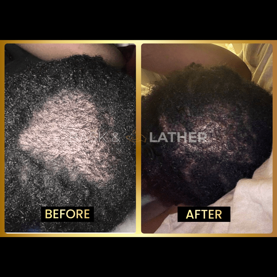 Scalp Stimulator - 3 Month Supply