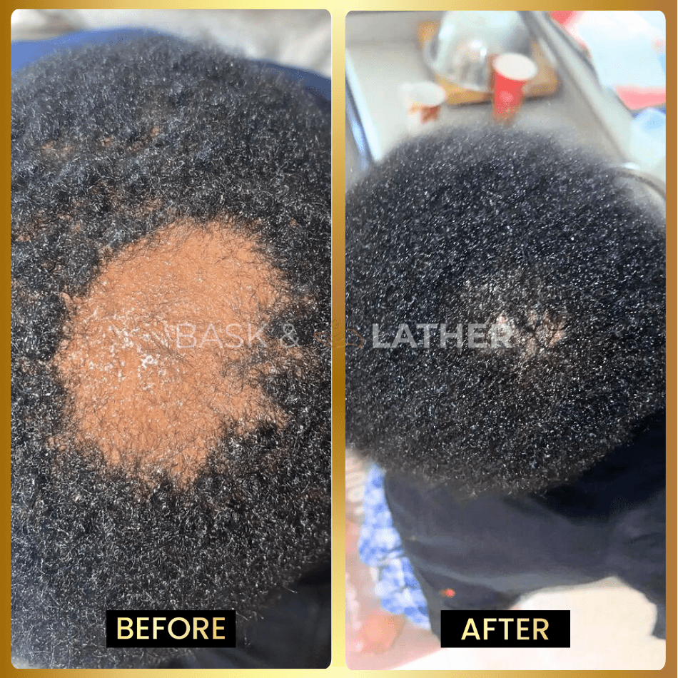 Scalp Stimulator - 3 Month Supply